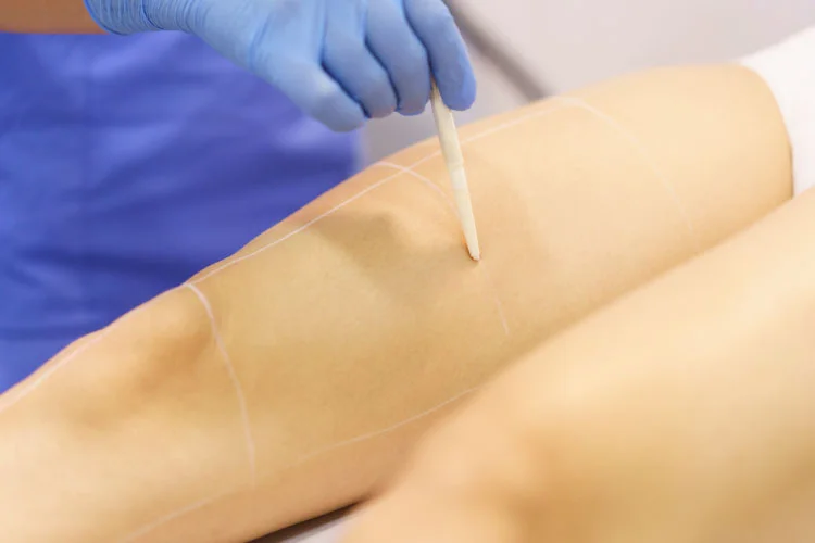 Servicio-de-depilacion-laser Explotación compartida con láser de Alejandrita en Granada